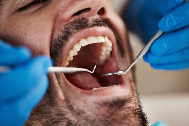 Best Emergency Wisdom Teeth Removal in Moss Bluff, LA