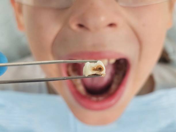 Best Emergency Tooth Extraction in Moss Bluff, LA