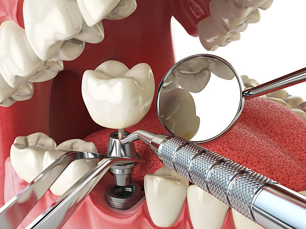 Best Emergency Tooth Extraction in Moss Bluff, LA